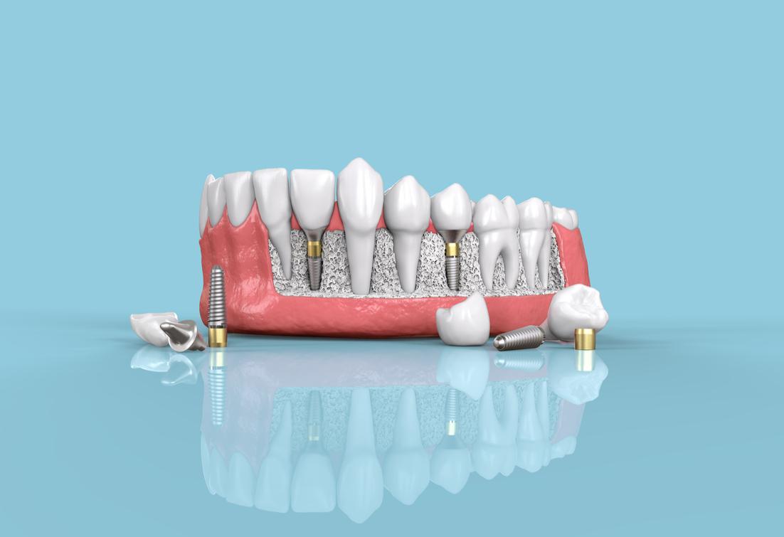 How Long do Dental Implants Last?