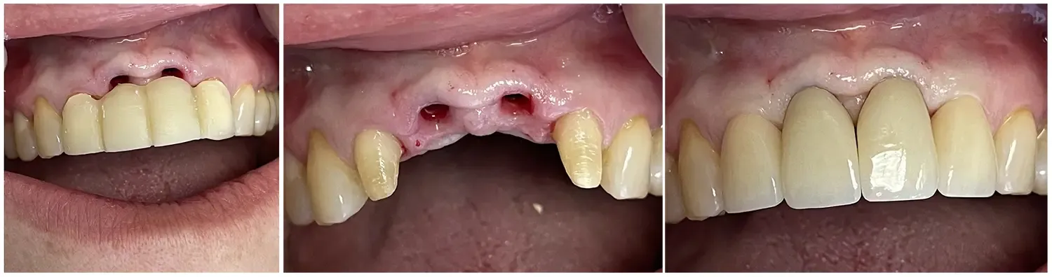 positive outcome dental implants and crown