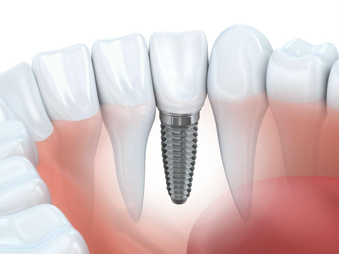 How to Avoid Common Dental Implant Problems