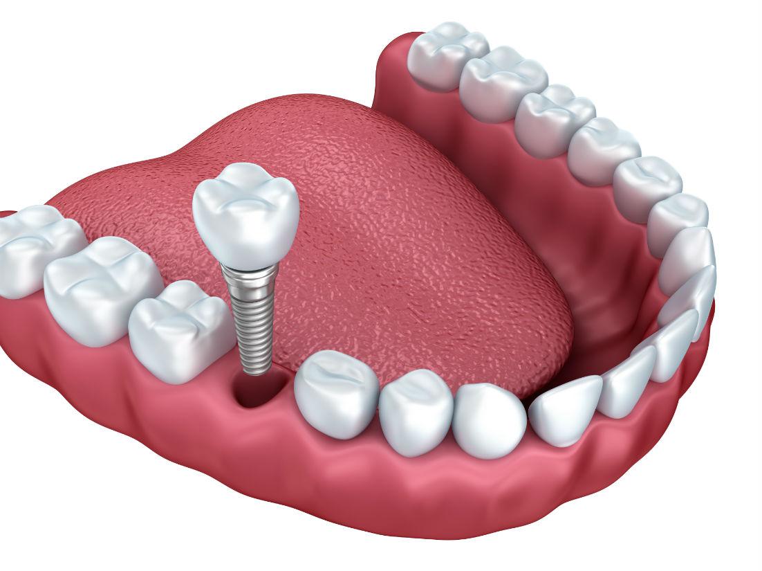Are Dental Implants Right for Me?