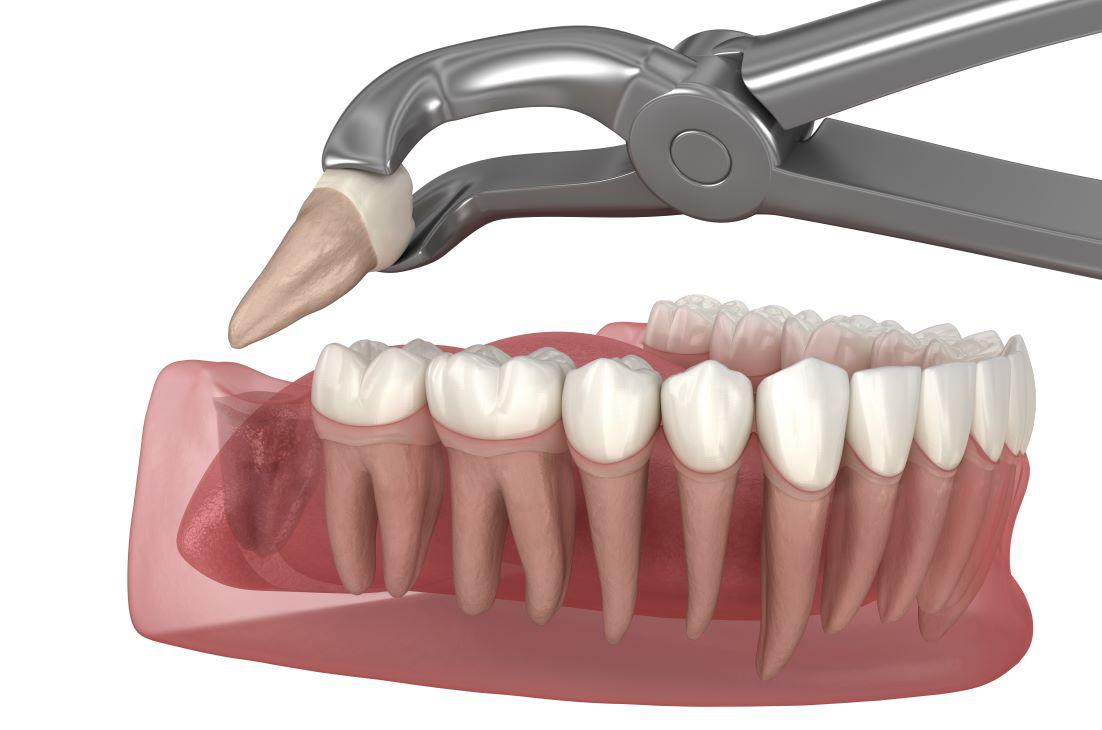 Impacted Tooth?  Symptoms, Removal, and Treatment