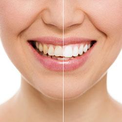 Teeth Whitening Calabasas, CA